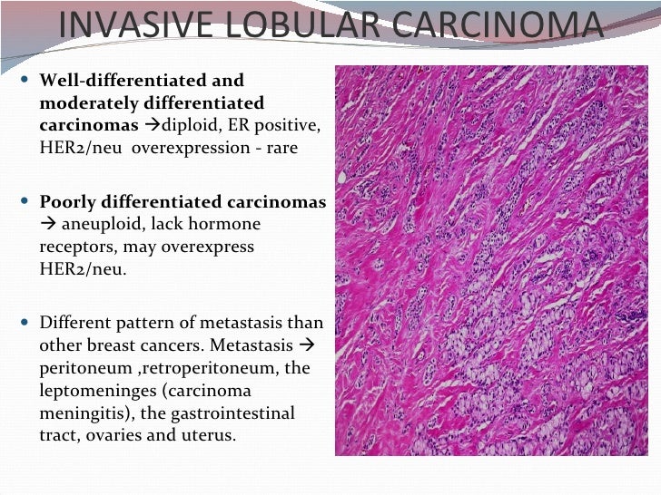 lobular invasive breast cancer Lobular invasive breast cancer